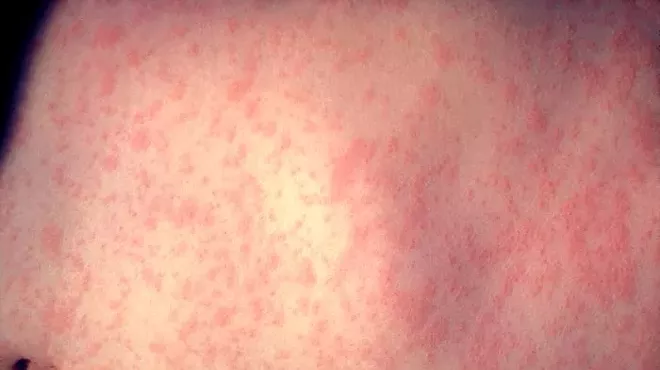 Image: Measles outbreak spreads, health officials urge unvaccinated to stay home