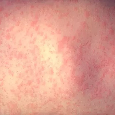 Image: Measles outbreak spreads, health officials urge unvaccinated to stay home