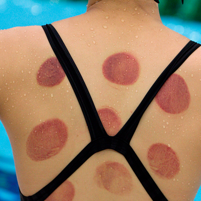 Cupping, healthcare costs stabilizing and vaccine season